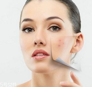 痘痘肌怎么補(bǔ)水 痘痘肌適合用的乳液推薦 痘痘肌怎么補(bǔ)水 痘痘肌適合用的乳液推薦