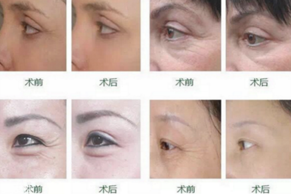 魚尾紋激光有副作用嗎 激光去除魚尾紋風險 魚尾紋激光有副作用嗎 激光去除魚尾紋風險