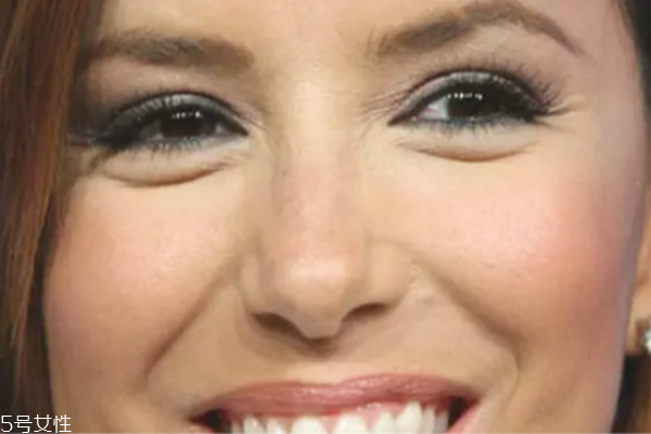 魚(yú)尾紋打玻尿酸管事嗎 快速秒殺眼部皺紋的方法 魚(yú)尾紋打玻尿酸管事嗎 快速秒殺眼部皺紋的方法