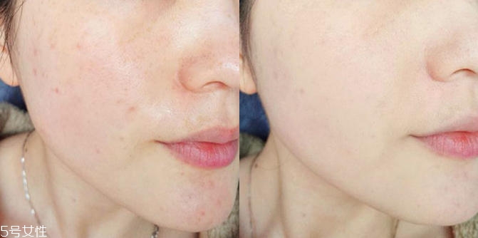 evm原液好用嗎 撫平痘痕就靠它 evm原液好用嗎 撫平痘痕就靠它