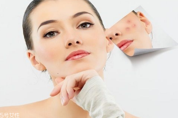 痘痘肌適合用什么護(hù)膚品 這五個(gè)口碑超好