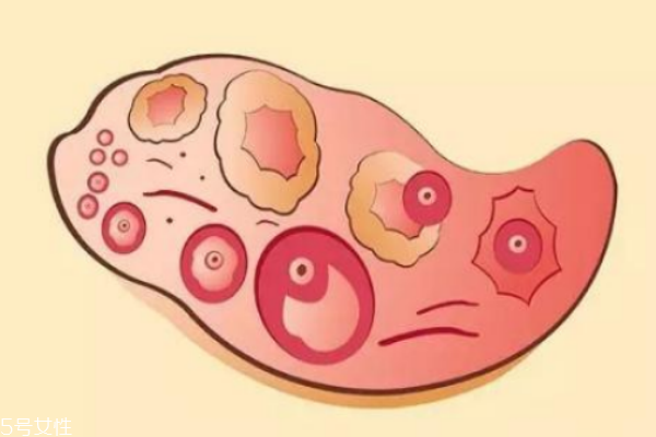 卵泡發(fā)育不良為何不首選促排 卵泡發(fā)育不良為何不首選促排