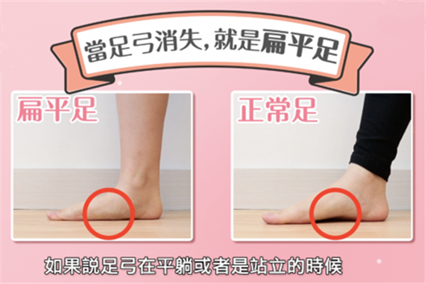 什么是扁平足 確診為扁平足要怎么恢復(fù) 什么是扁平足 確診為扁平足要怎么恢復(fù)