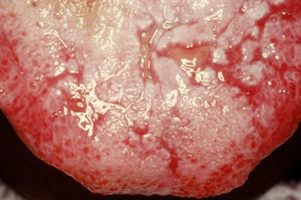 中醫(yī)教你從舌頭上看身體是否有疾病 中醫(yī)教你從舌頭上看身體是否有疾病