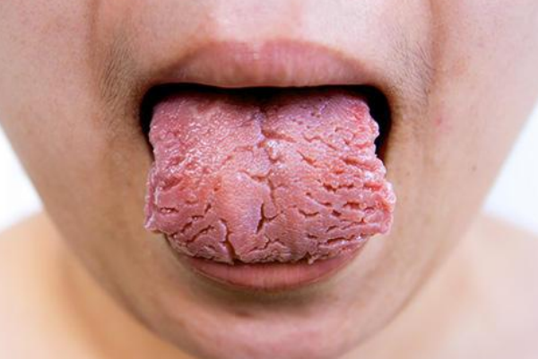 中醫(yī)教你從舌頭上看身體是否有疾病 中醫(yī)教你從舌頭上看身體是否有疾病