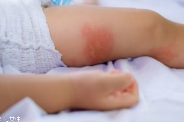 寶寶濕疹是怎么引起的 正確護(hù)理寶寶的方式 寶寶濕疹是怎么引起的 正確護(hù)理寶寶的方式