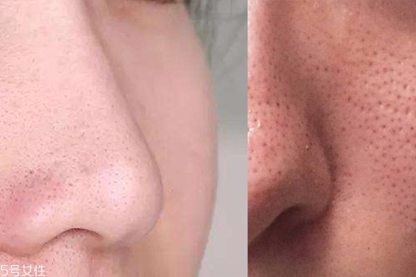 油性皮膚毛孔怎么縮小 3個步驟養(yǎng)出無瑕陶瓷肌 油性皮膚毛孔怎么縮小 3個步驟養(yǎng)出無瑕陶瓷肌