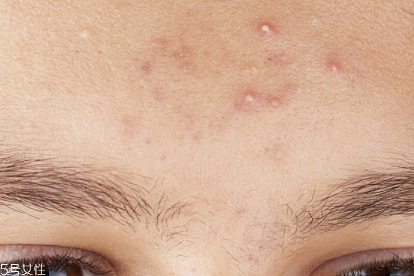 祛痘產(chǎn)品哪個好 口碑最好的祛痘產(chǎn)品 祛痘產(chǎn)品哪個好 口碑最好的祛痘產(chǎn)品