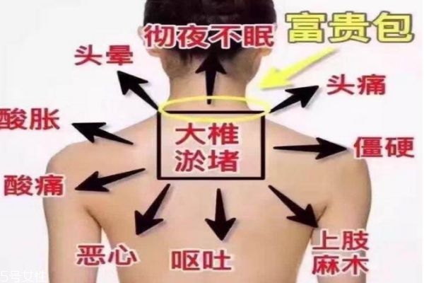 富貴包會引起什么病 教你如何預防