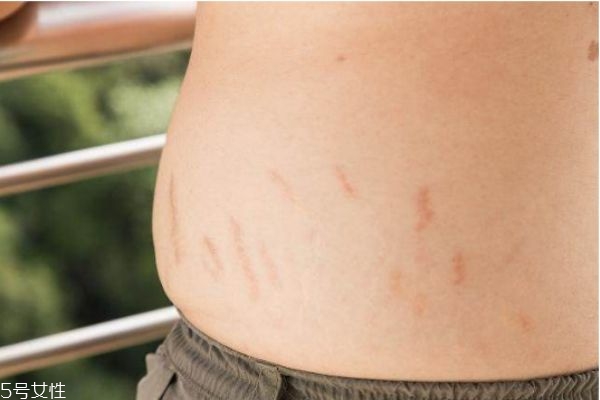 妊娠紋可以祛除嗎 教你怎么預(yù)防妊娠紋生長 妊娠紋可以祛除嗎 教你怎么預(yù)防妊娠紋生長