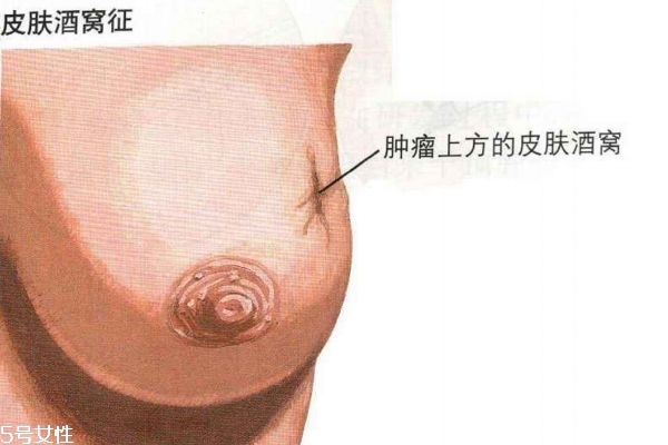 乳腺癌的早期癥狀 帶你認(rèn)識(shí)乳腺癌 乳腺癌的早期癥狀 帶你認(rèn)識(shí)乳腺癌
