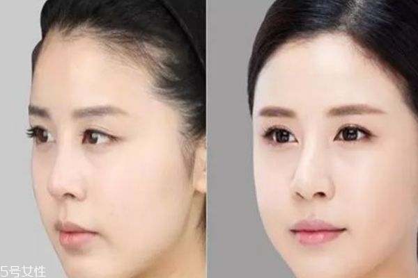 蘋果肌塌陷怎么辦 蘋果肌在哪個位置 蘋果肌塌陷怎么辦 蘋果肌在哪個位置