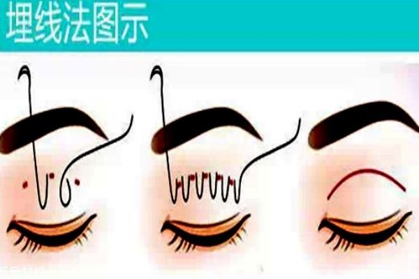 韓式三點(diǎn)和埋線(xiàn)的區(qū)別 你適合做什么樣的