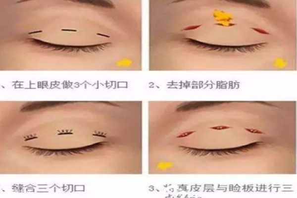 韓式三點(diǎn)和埋線(xiàn)的區(qū)別 你適合做什么樣的