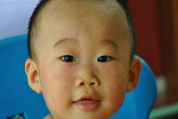 幼兒急疹的癥狀及治療 家長們要注意