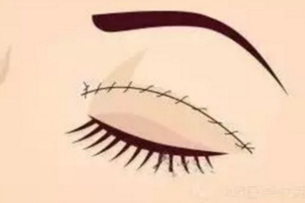 割完雙眼皮多久可以洗臉 割完雙眼皮多久可以洗臉