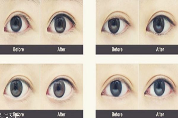 紋眼線(xiàn)是永久的嗎 理論上是的