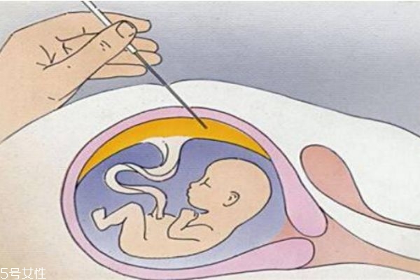孕婦做羊水穿刺對(duì)胎兒有影響嗎 孕婦做羊水穿刺對(duì)胎兒有影響嗎