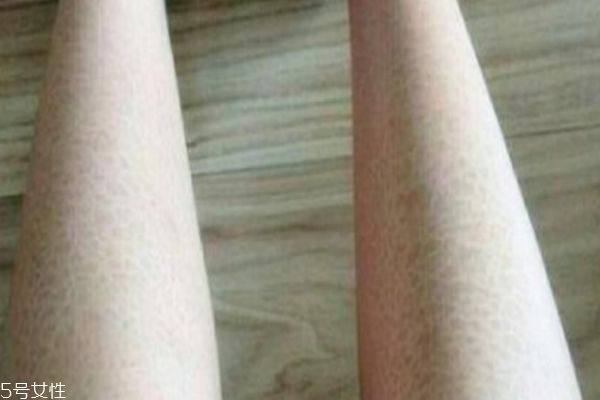 腿上皮膚干燥像魚鱗 有可能是魚鱗病 腿上皮膚干燥像魚鱗 有可能是魚鱗病