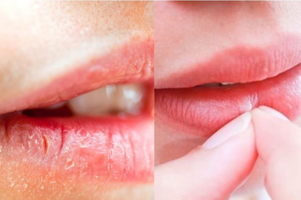如何去除嘴部死皮 教你不傷嘴唇的方式 如何去除嘴部死皮 教你不傷嘴唇的方式