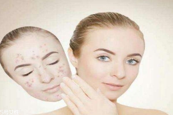 激素臉治療方法 如何判斷是否是激素臉 激素臉治療方法 如何判斷是否是激素臉