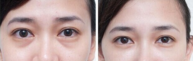 淚溝能自己恢復(fù)嗎？淚溝怎么自己恢復(fù)？