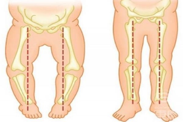 寶寶走路內(nèi)八字怎么辦 教你如何矯正 寶寶走路內(nèi)八字怎么辦 教你如何矯正