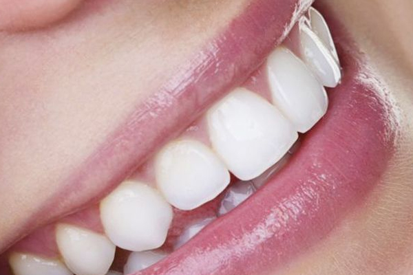 牙齒美白有哪些技術(shù) 4種技術(shù)怎么選擇 牙齒美白有哪些技術(shù) 4種技術(shù)怎么選擇