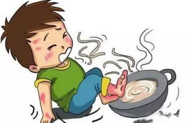 燙傷涂牙膏管用嗎 千萬不要涂牙膏啦 燙傷涂牙膏管用嗎 千萬不要涂牙膏啦