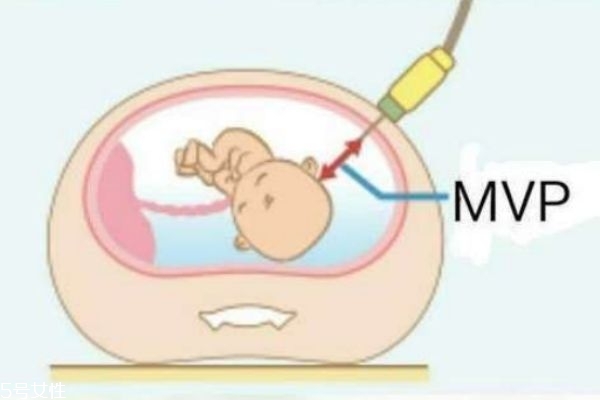 孕婦羊水過多對胎兒有害嗎 會危及胎兒性命 孕婦羊水過多對胎兒有害嗎 會危及胎兒性命