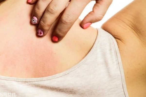 如何消除背部的痘痘 4招讓你告別背上的痘痘 如何消除背部的痘痘 4招讓你告別背上的痘痘