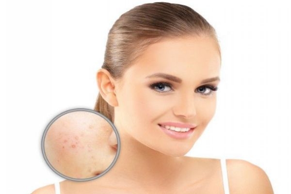 痘痘里為什么會(huì)有膿 臉上長(zhǎng)膿痘怎么調(diào)理 痘痘里為什么會(huì)有膿 臉上長(zhǎng)膿痘怎么調(diào)理