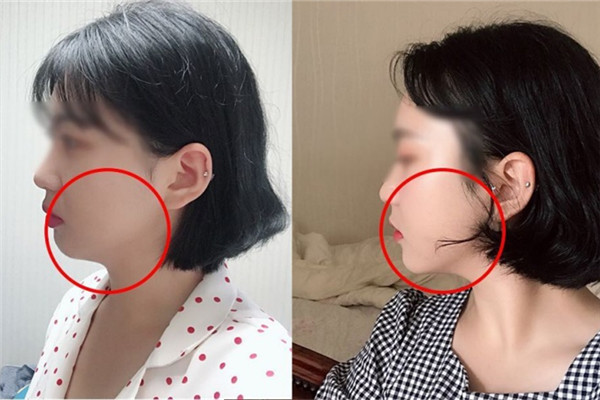 耳貼減肥有效嗎 耳貼減肥有人用過嗎 耳貼減肥有效嗎 耳貼減肥有人用過嗎