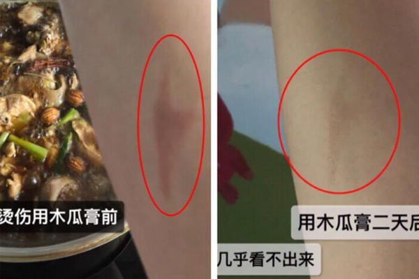 澳洲木瓜膏能治燙傷嗎 澳洲木瓜膏能止癢嗎 澳洲木瓜膏能治燙傷嗎 澳洲木瓜膏能止癢嗎