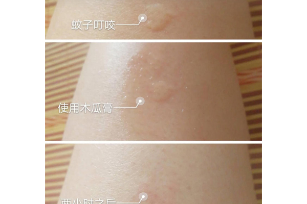 澳洲木瓜膏能治燙傷嗎 澳洲木瓜膏能止癢嗎 澳洲木瓜膏能治燙傷嗎 澳洲木瓜膏能止癢嗎