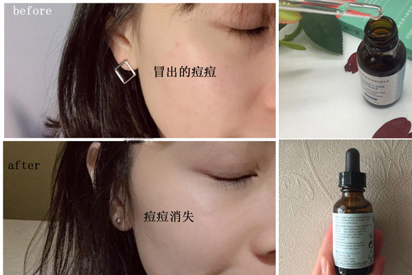 修麗可果酸精華液祛痘效果好嗎 戰(zhàn)痘力超強(qiáng)神器 修麗可果酸精華液祛痘效果好嗎 戰(zhàn)痘力超強(qiáng)神器