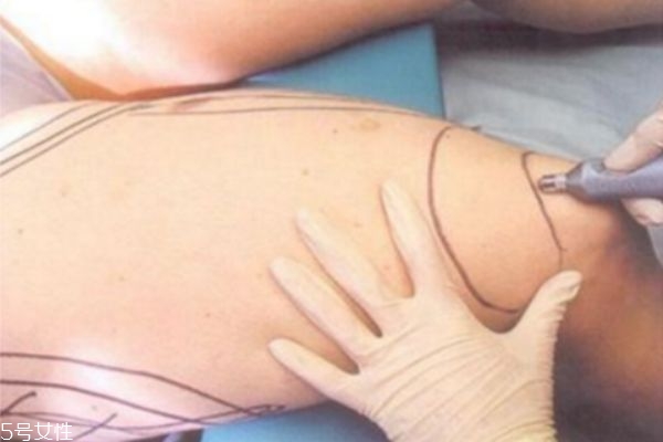 大腿環(huán)形吸脂多久完全消腫 抽脂瘦腿有哪些后遺癥 大腿環(huán)形吸脂多久完全消腫 抽脂瘦腿有哪些后遺癥