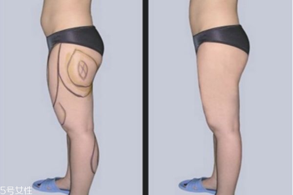 大腿環(huán)形吸脂多久完全消腫 抽脂瘦腿有哪些后遺癥 大腿環(huán)形吸脂多久完全消腫 抽脂瘦腿有哪些后遺癥