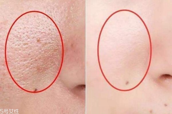 皮膚細膩零毛孔，教你三招搞定