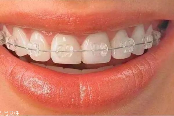 牙齒整形有危害嗎 牙齒整形的危害 牙齒整形有危害嗎 牙齒整形的危害