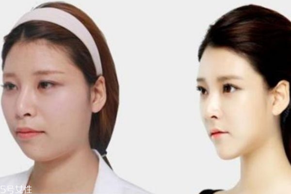 削骨多少錢 整骨適合人群 削骨多少錢 整骨適合人群