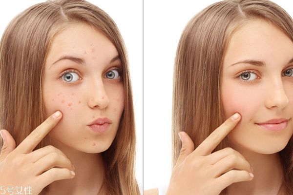 美白祛斑有哪些小竅門 美白祛斑小竅門 美白祛斑有哪些小竅門 美白祛斑小竅門