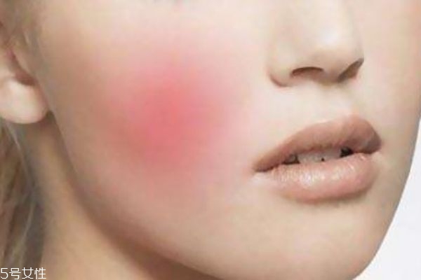 紅血絲是什么 紅血絲怎么護(hù)理 紅血絲是什么 紅血絲怎么護(hù)理