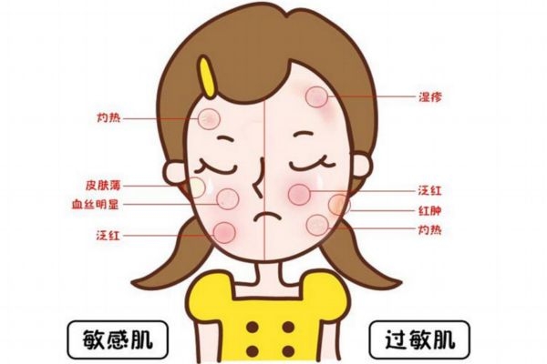 敏感肌膚怎么修復(fù)好 敏感皮膚需要注意哪些事項