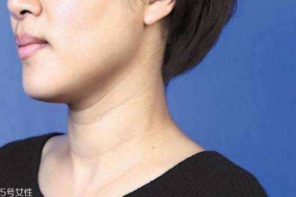 很年輕為什么就有頸紋 頸紋是這樣長出來的 很年輕為什么就有頸紋 頸紋是這樣長出來的