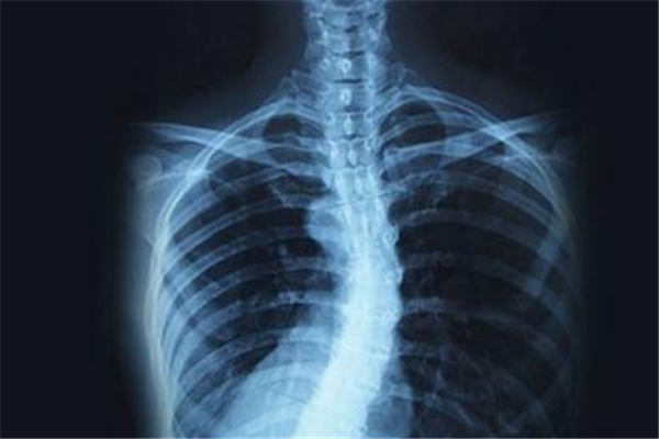 脊椎側(cè)彎造成胸悶、背部疼痛