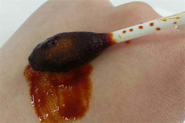 衣服上的碘伏怎么洗掉 印記去無(wú)蹤 衣服上的碘伏怎么洗掉 印記去無(wú)蹤