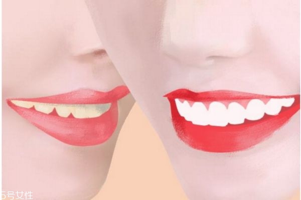 牙黃變白最實用的方法 低成本牙齒美白小妙招 牙黃變白最實用的方法 低成本牙齒美白小妙招