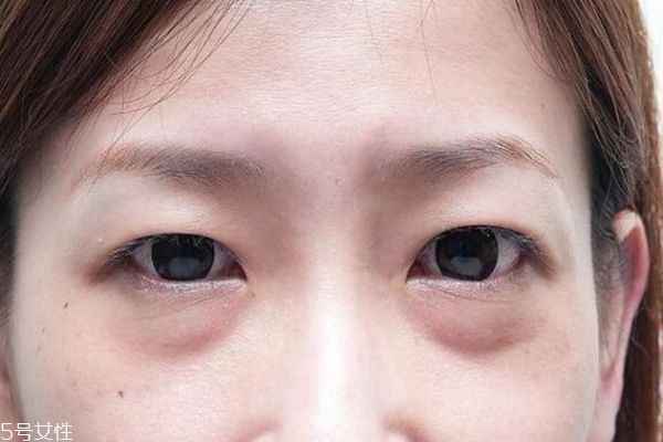 內(nèi)切眼袋會不會影響視力 內(nèi)切眼袋后如何消腫 內(nèi)切眼袋會不會影響視力 內(nèi)切眼袋后如何消腫
