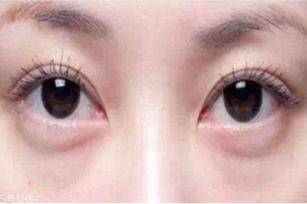 內(nèi)切眼袋會不會影響視力 內(nèi)切眼袋后如何消腫 內(nèi)切眼袋會不會影響視力 內(nèi)切眼袋后如何消腫